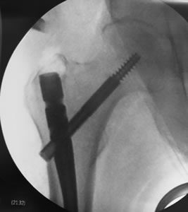 Tratamiento de fracturas de cadera