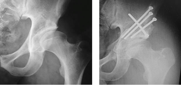 osteotomias